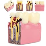 Zahnkaries-Zahnmodell, Vergleichsstudienmodell Für Karieszähne Mit...